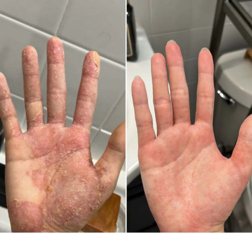 Dermatitis Control & Healthy Skin Cream - Relieves Itching, Redness & Flaking 50ml photo review